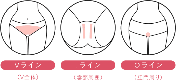ハイジニーナ脱毛