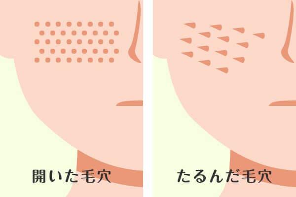 開き毛穴・たるみ毛穴