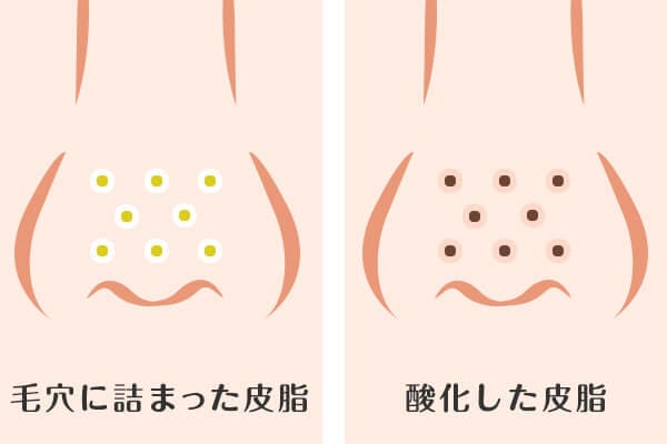 詰まり毛穴・黒ずみ