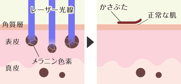 どのような仕組みでシミが除去される？