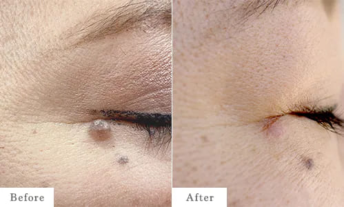 CO2レーザーのbefore after