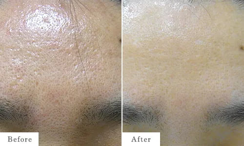 ACRS（再生治療）のbefore after