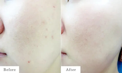 ゼオスキンヘルスのbefore after
