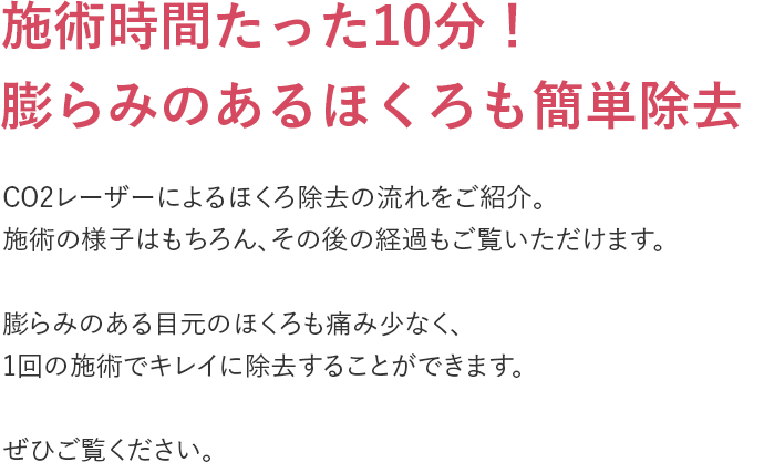 施術時間たった10分！膨らみのあるほくろも簡単除去
