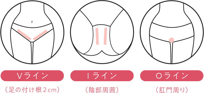 VIO（エチケット脱毛）