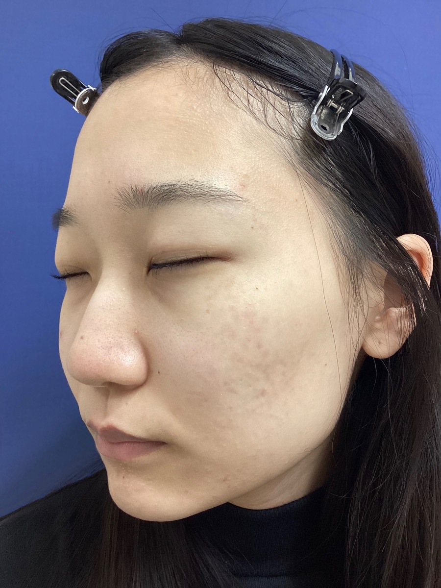 光線治療の施術後
