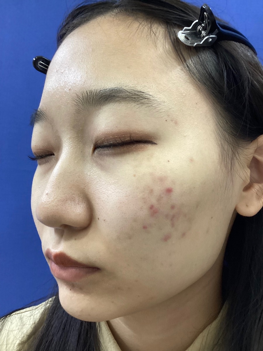 光線治療の施術前