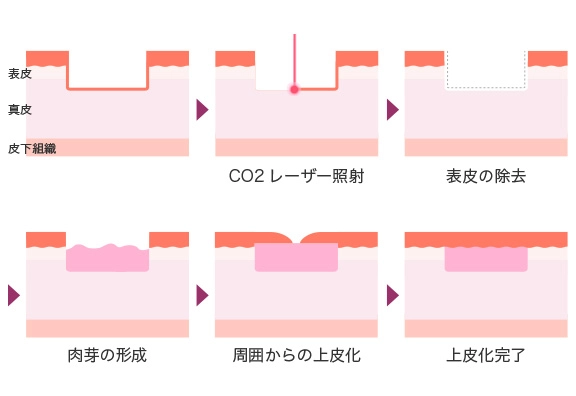 アブレージョンとは