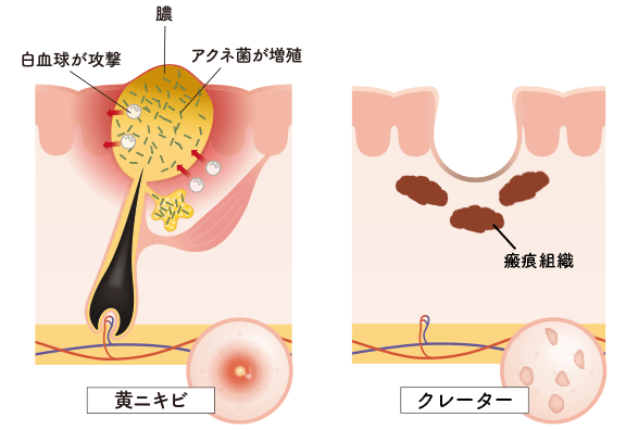 クレーター（陥没）が起きる仕組み