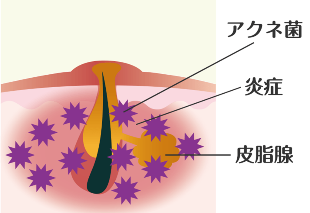 黄ニキビ