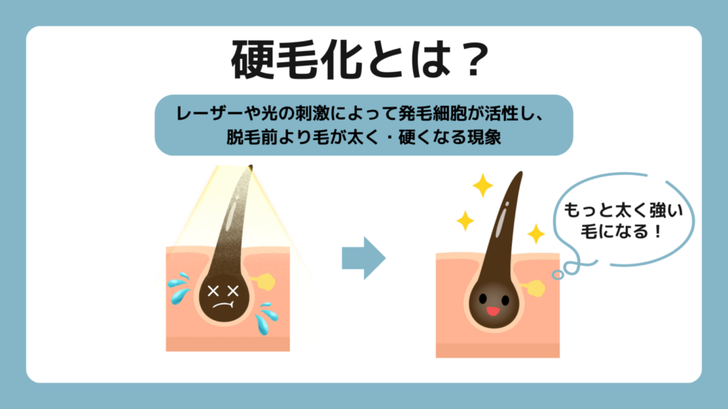 硬毛化とは。レーザーや光の刺激によって発毛細胞が活性し、脱毛前より毛が太く硬くなる現象