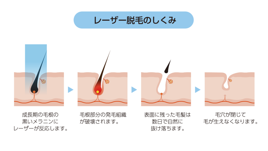レーザー脱毛のしくみ。成長期の毛根の黒いメラニンにレーザーが反応し、発毛組織が破壊され、毛が抜け落ちて毛穴が閉じる