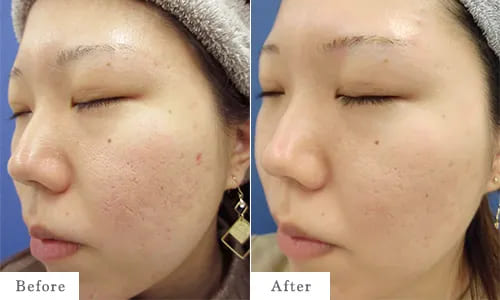 ニキビ跡治療のbefore after