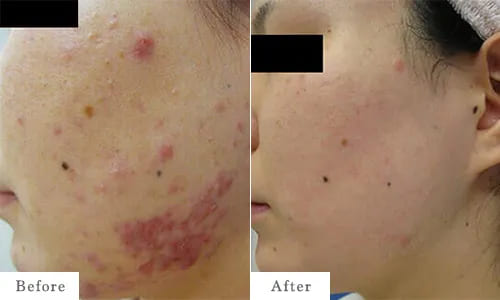 ケミカルピーリングのbefore after