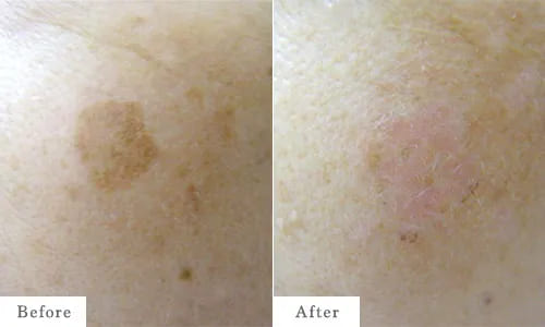 シミ治療のbefore after