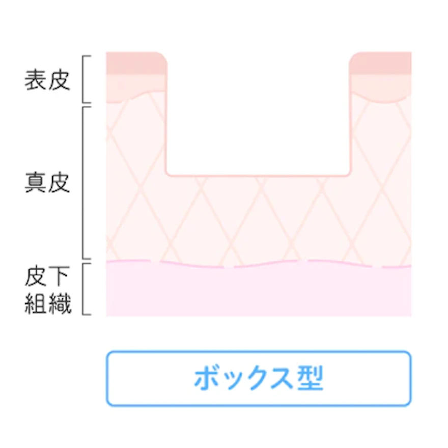 ボックス型