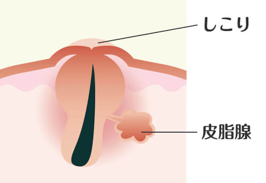 ニキビのしこりの原因