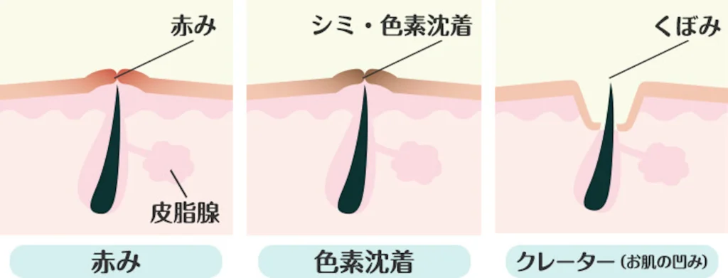 ニキビ跡になる可能性が高まるため
