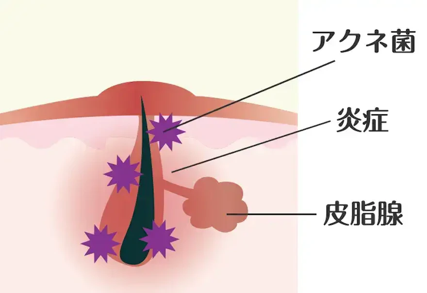 ニキビの炎症