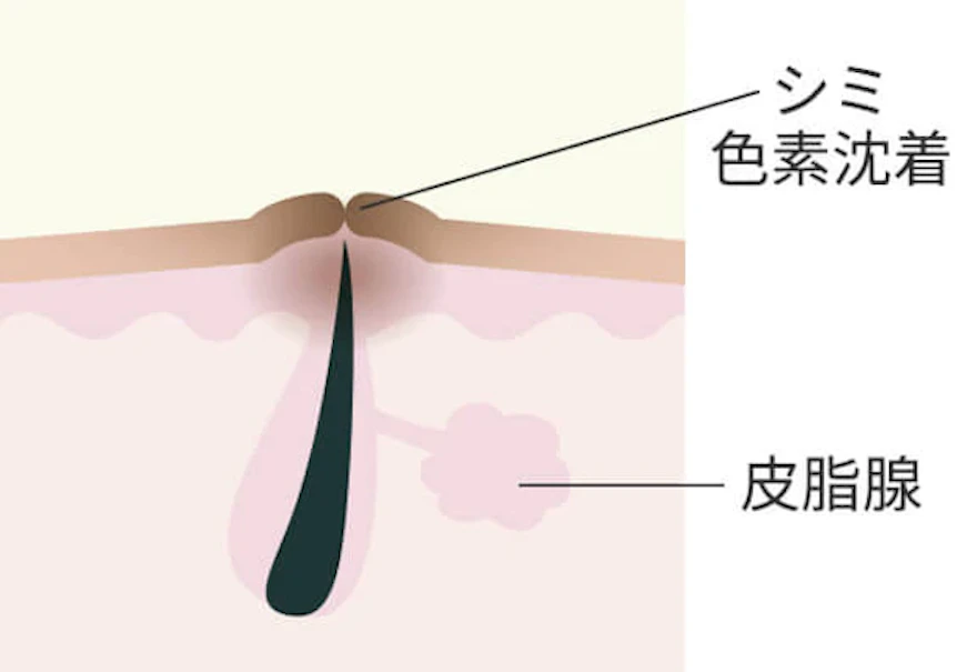 色素沈着タイプのニキビ跡になるメカニズム