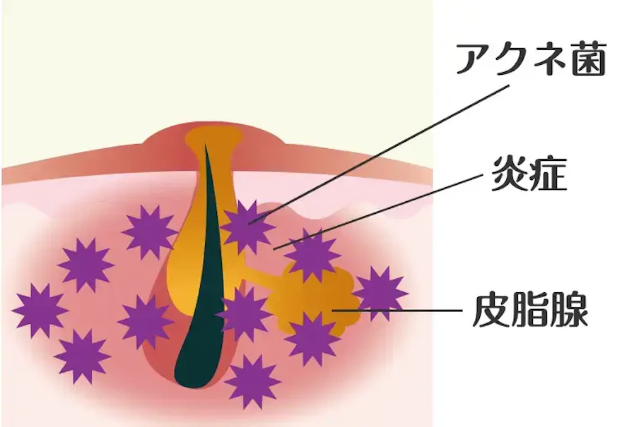 ニキビの化膿