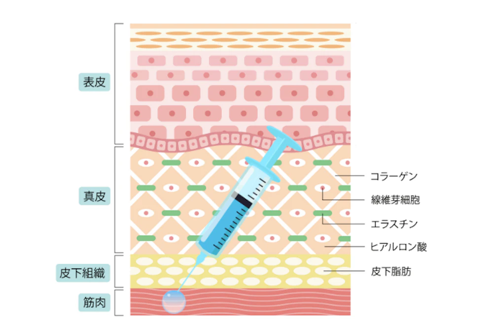 ボトックス注射