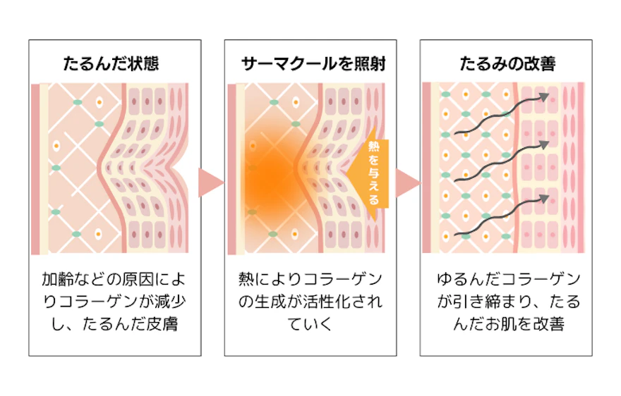 サーマクールのメカニズム