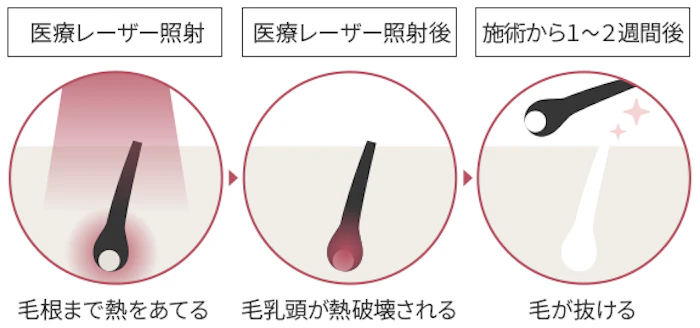 医療脱毛は何回で効果がでるの？