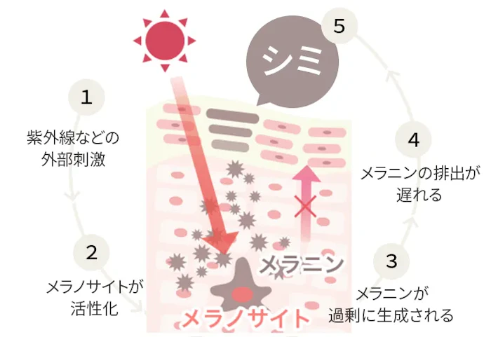 シミやそばかすができる主な原因は「メラニン」