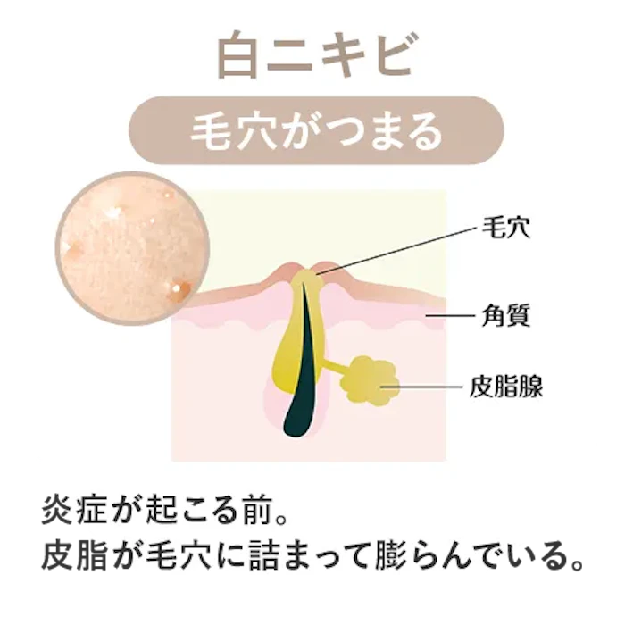 炎症のないニキビ「白ニキビ」「黒ニキビ」