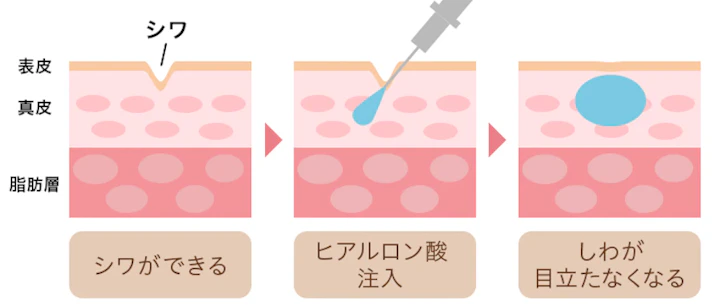 ヒアルロン酸注射の効果