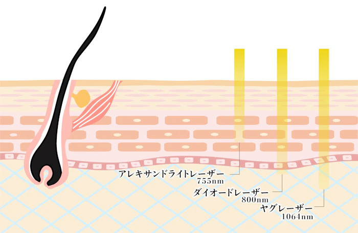 熱破壊式（ショット式）のレーザーの種類は3種類