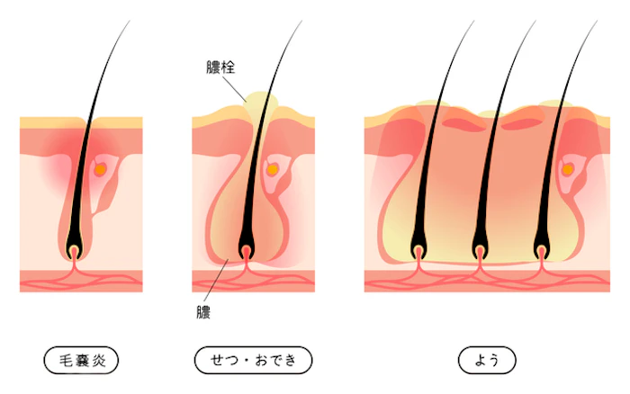 毛嚢炎（もうのうえん）とは？