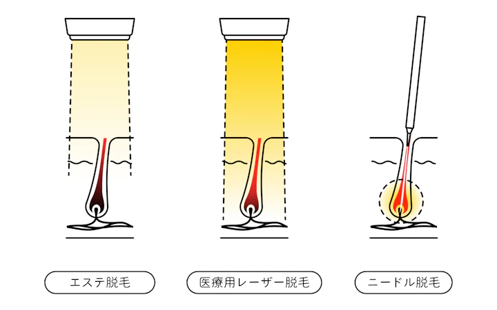 代替手段①「ニードル脱毛」による永久脱毛