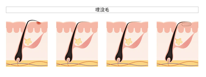 埋没毛の原因になり得る