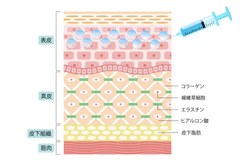 マイクロボトックス