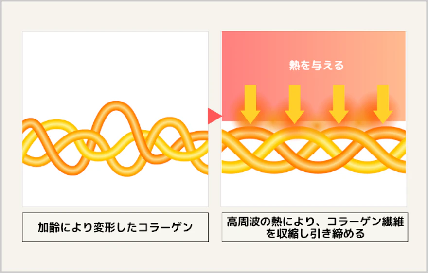 コラーゲン線維の収縮