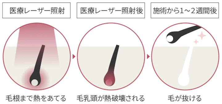 白髪になるとレーザー脱毛できない3つの理由