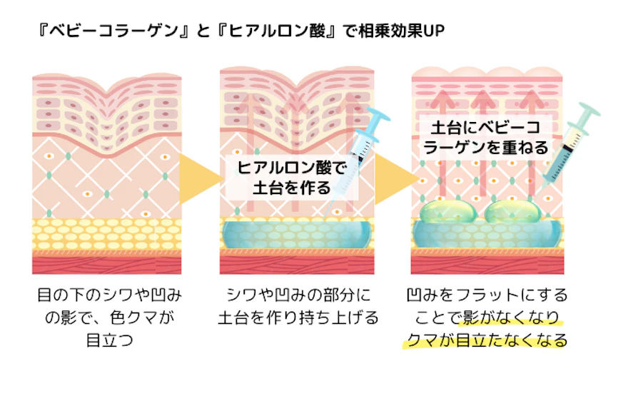 ヒアルロン注射