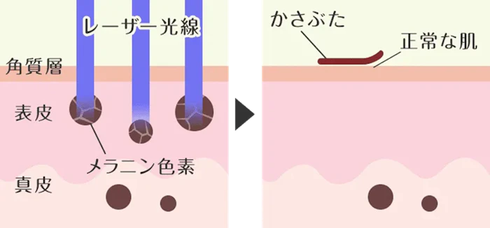 シミが薄くならなかった