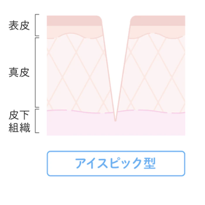 ①アイスピック型