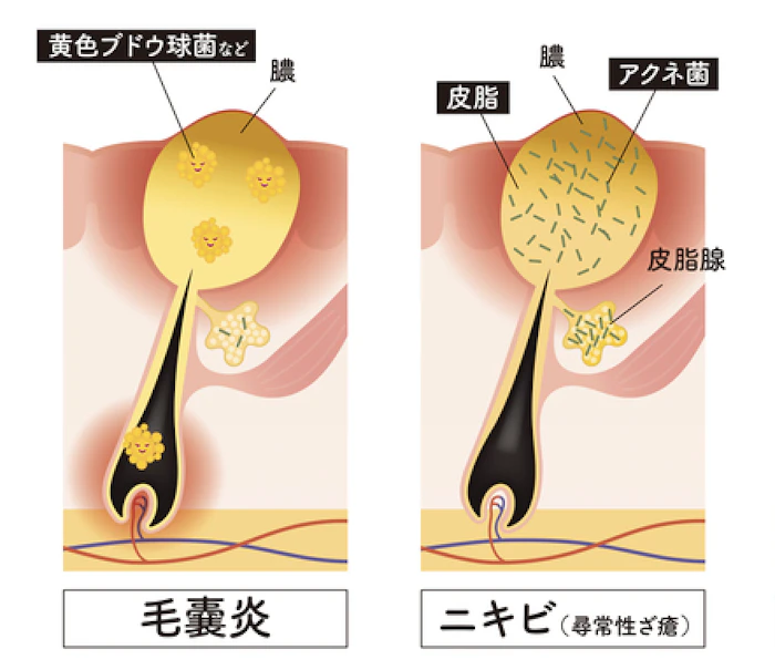 毛嚢炎とニキビとの違い