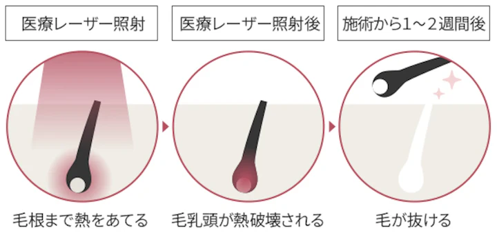 医療脱毛が永久脱毛になる仕組みとは