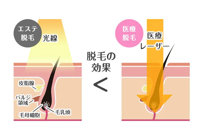 脱毛サロンで受ける「光脱毛」は永久脱毛ではない