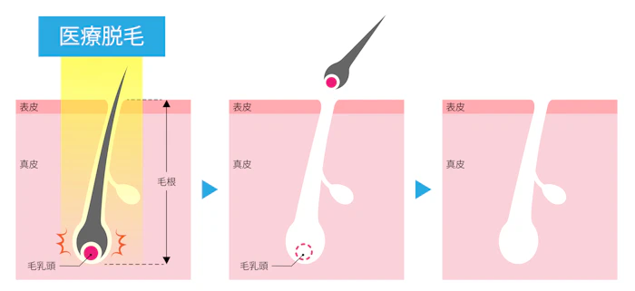 医療レーザー脱毛の仕組み