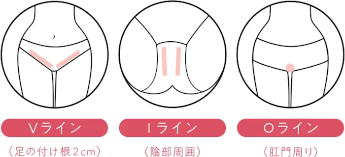 V・I・Oをまとめ脱毛をするパターンも