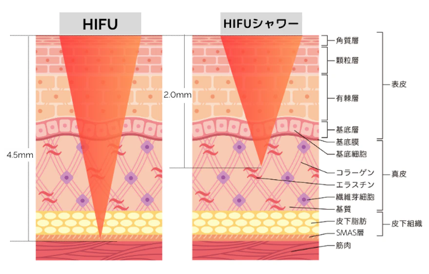 皮膚を引き締めるハイフシャワーとは？