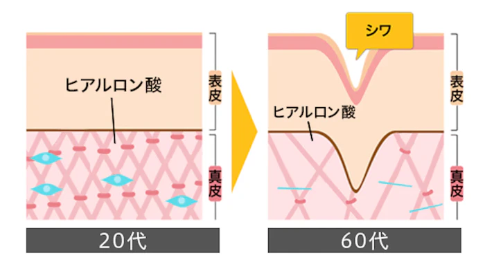 ほうれい線のヒアルロン酸注入でよくある失敗