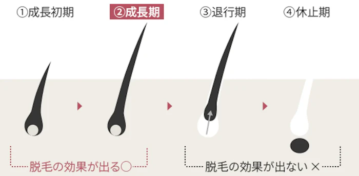 医療レーザー脱毛の仕組み