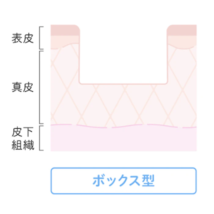 ③ボックス型